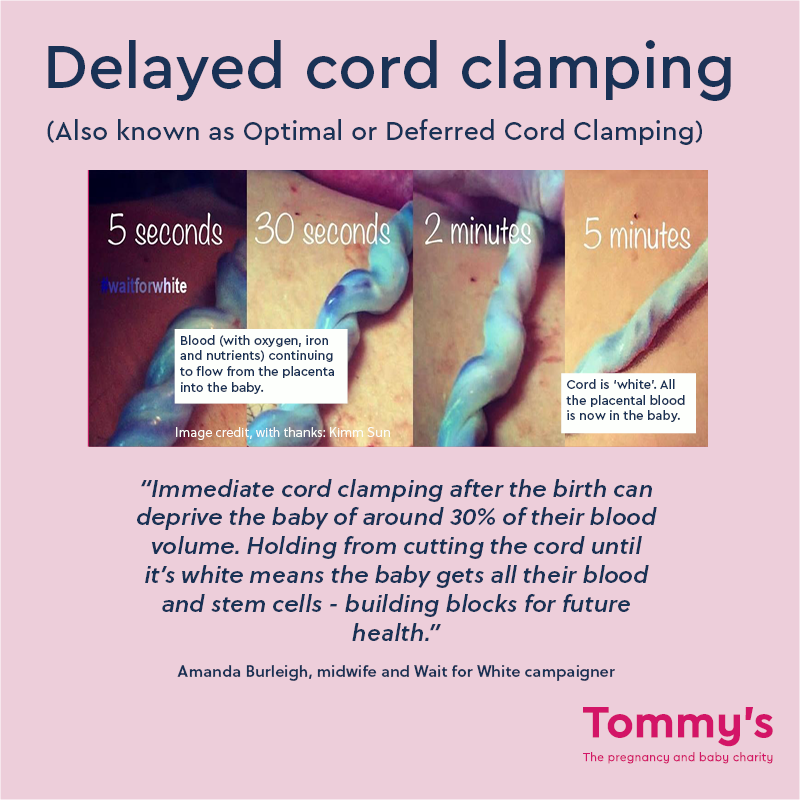 Effect of delayed cord clamping shown at 5 sec, 30 sec, 2 min and 5 min.