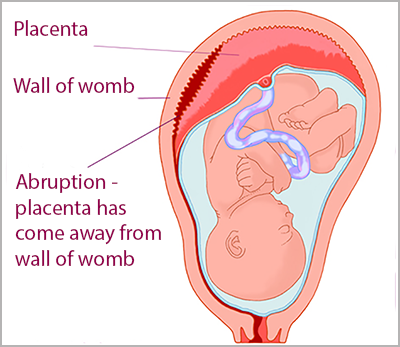 plancental abruption diagram